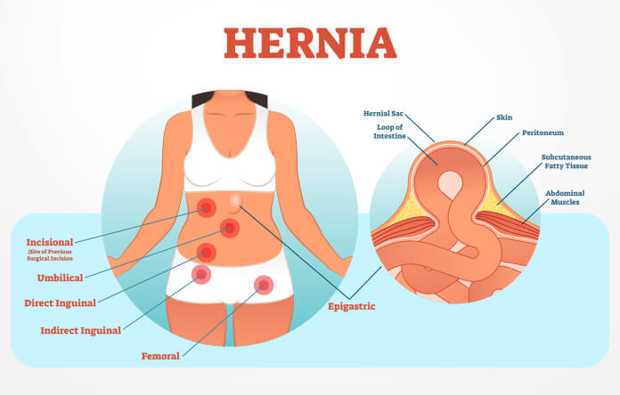 Hernia- types, causes, symptoms, treatment, and prevention